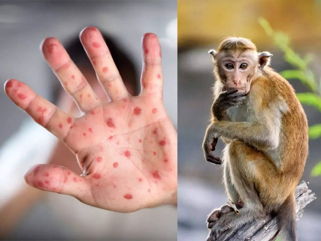 Maymun Çiçeği Virüsü Belirtileri Nelerdir